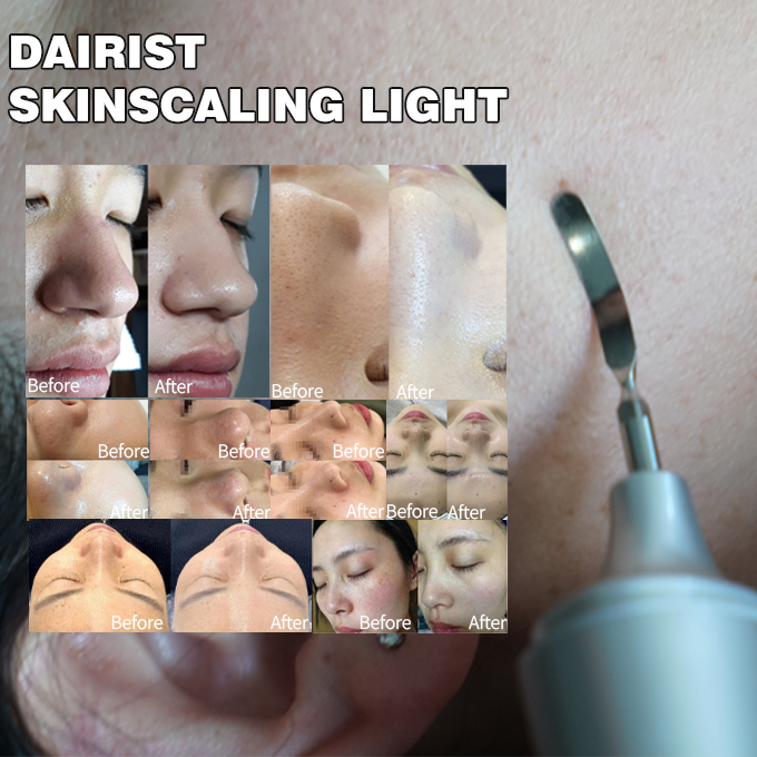Portable Hand-held Skinscaling Home Use Beauty Machine Exfoliation Blackhead Vibration Pore Cleansing Deep Cleansing Skin Scrubber